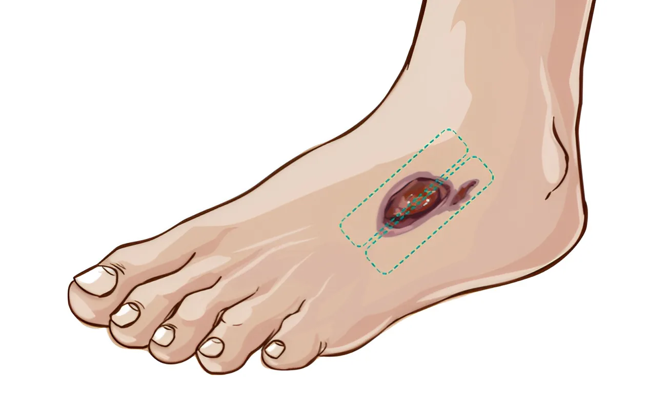 treatment foot ulcer